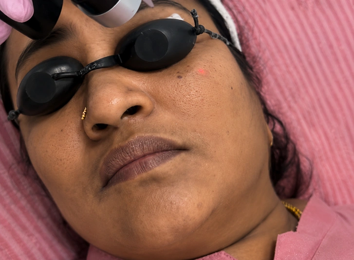 Why choose SkinLab for Hyperpigmentation treatment in Mysore