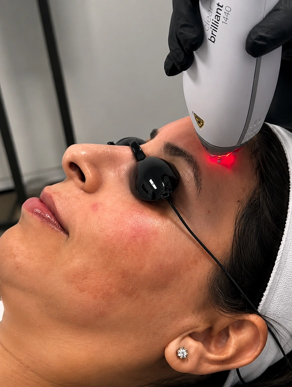 Hyperpigmentation treatment in Mysuru